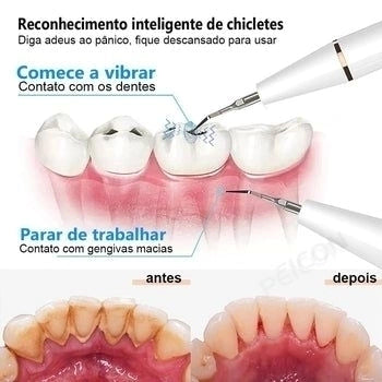 Removedor De Tártaro Elétrico